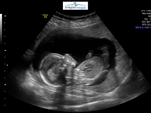 Ultrasound during pregnancy - 2D