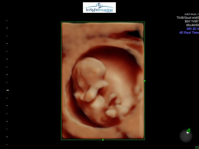 Ultrasound during pregnancy - 5D